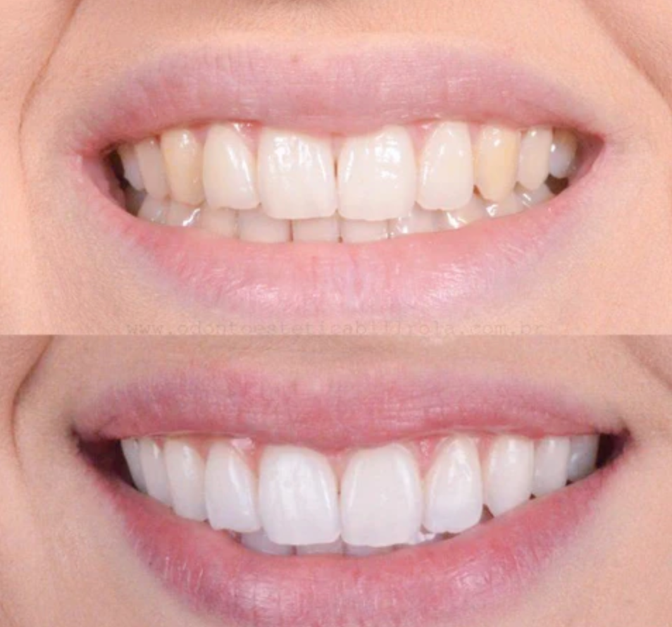 BrightSmile™ – Sbiancamento dentale ispirato ai trattamenti professionali da utilizzare a casa
