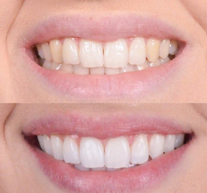 BrightSmile™ – Sbiancamento dentale ispirato ai trattamenti professionali da utilizzare a casa
