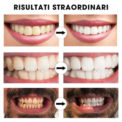 BrightSmile™ – Sbiancamento dentale ispirato ai trattamenti professionali da utilizzare a casa
