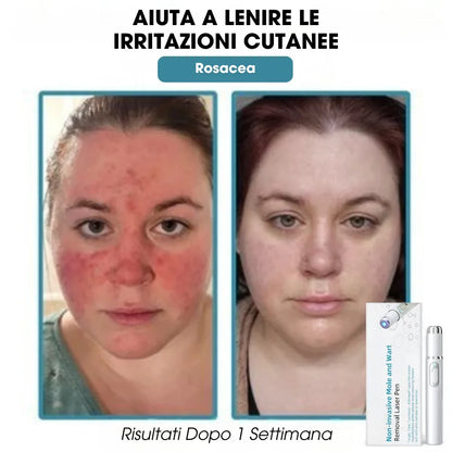 DermaLight Pro™ – Penna laser non invasiva per nei, verruche e fibromi cutanei