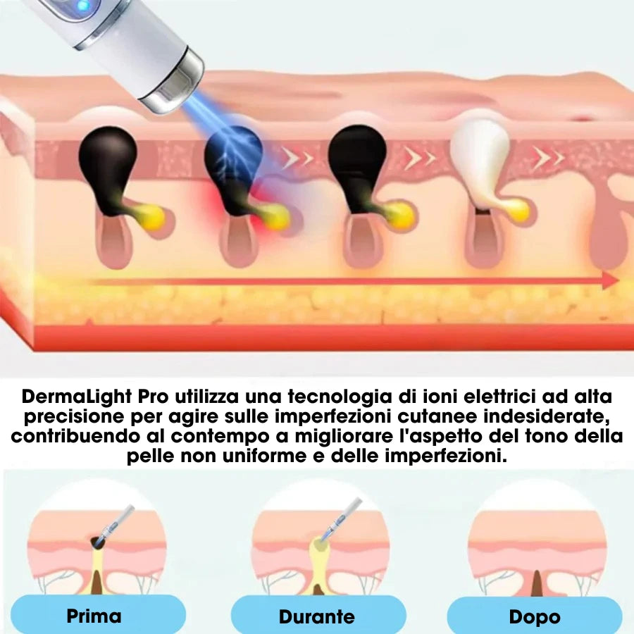 DermaLight Pro™ – Penna laser non invasiva per nei, verruche e fibromi cutanei