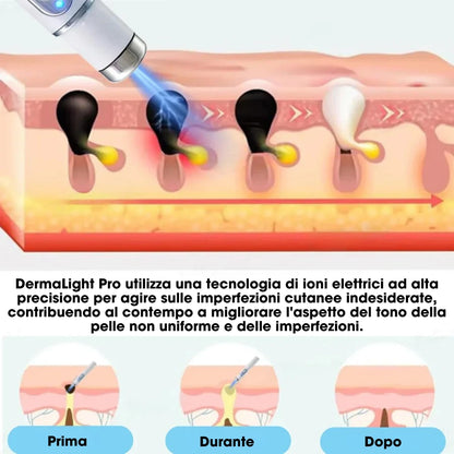DermaLight Pro™ – Penna laser non invasiva per nei, verruche e fibromi cutanei