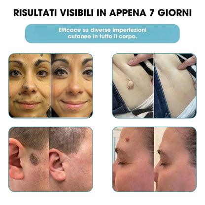 DermaLight Pro™ – Penna laser non invasiva per nei, verruche e fibromi cutanei