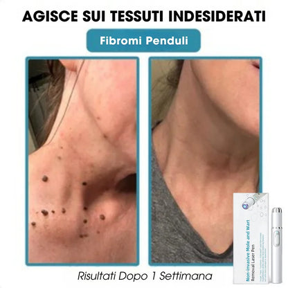 DermaLight Pro™ – Penna laser non invasiva per nei, verruche e fibromi cutanei