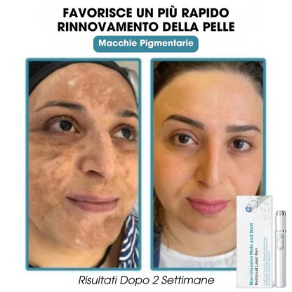 DermaLight Pro™ – Penna laser non invasiva per nei, verruche e fibromi cutanei